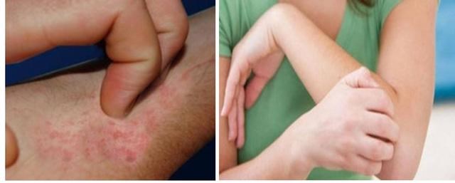 Điều cần biết khi bị ngứa mùa lạnh