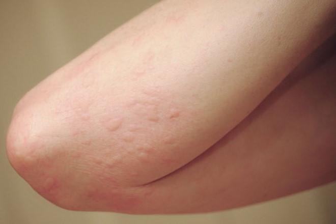 Điều cần biết khi bị ngứa mùa lạnh