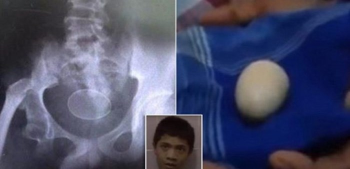Sự thật về cậu bé biết đẻ trứng tại Indonesia