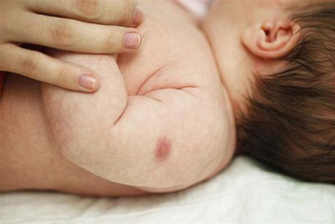 Cha mẹ cần lưu ý khi trẻ bị biến chứng sau tiêm vaccine