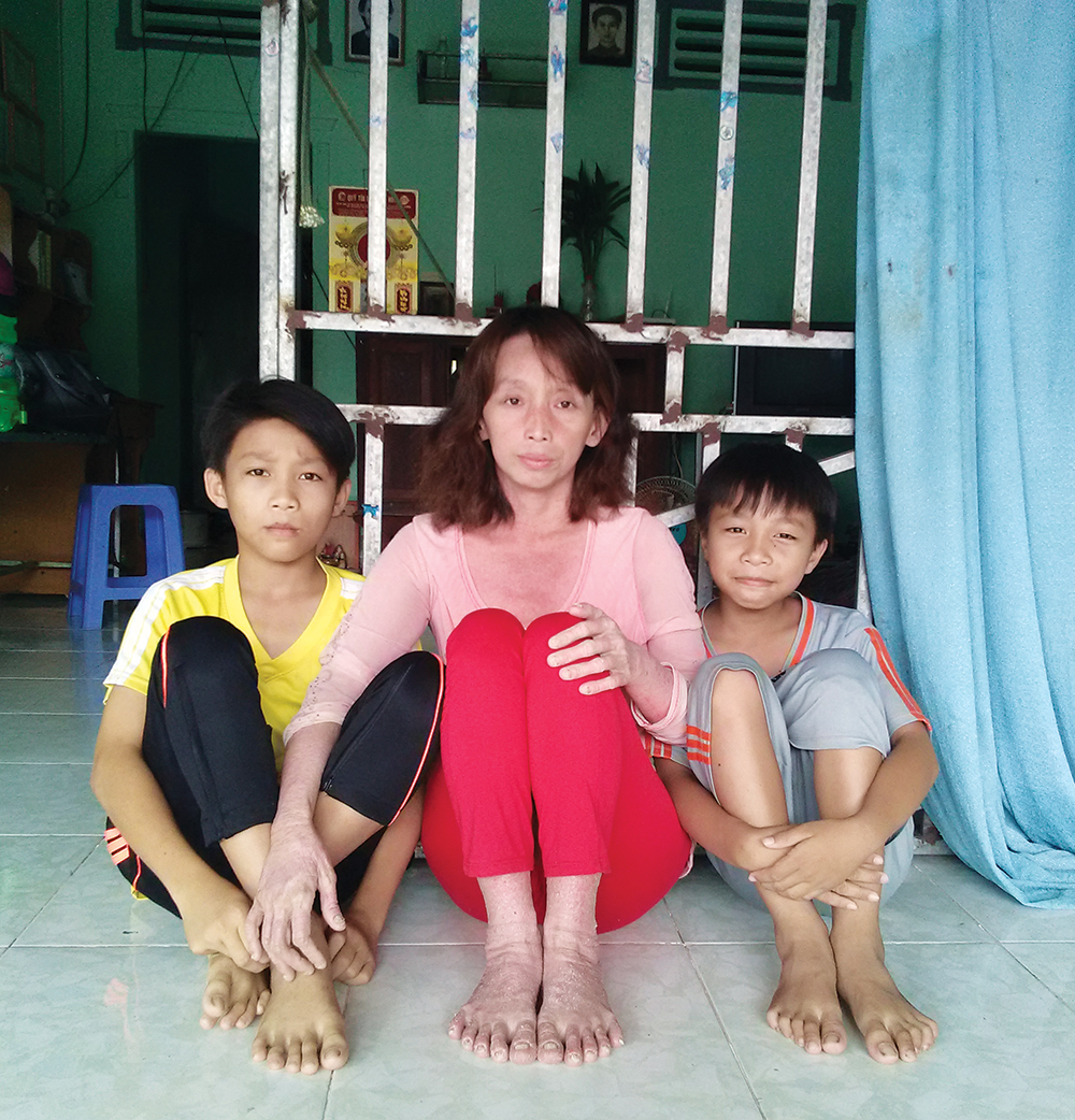 12 năm khổ sở vì căn bệnh vẩy nến hành hạ 12 năm khổ sở vì căn bệnh vẩy nến hành hạ