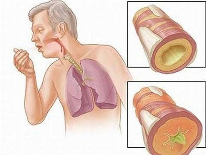 4 cách làm sạch phổi phòng tránh ung thư