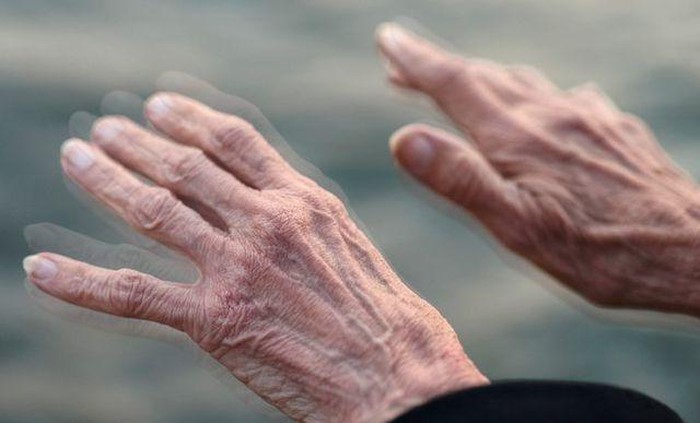 Phẫu thuật kích thích não sâu - hy vọng mới cho bệnh nhân Parkinson