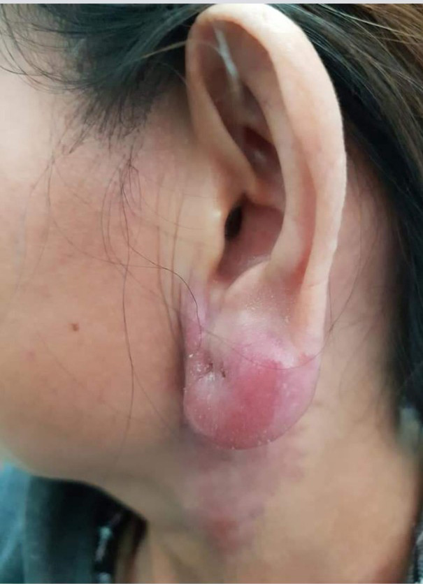 Làm gì khi bị biến chứng do tiêm filler?