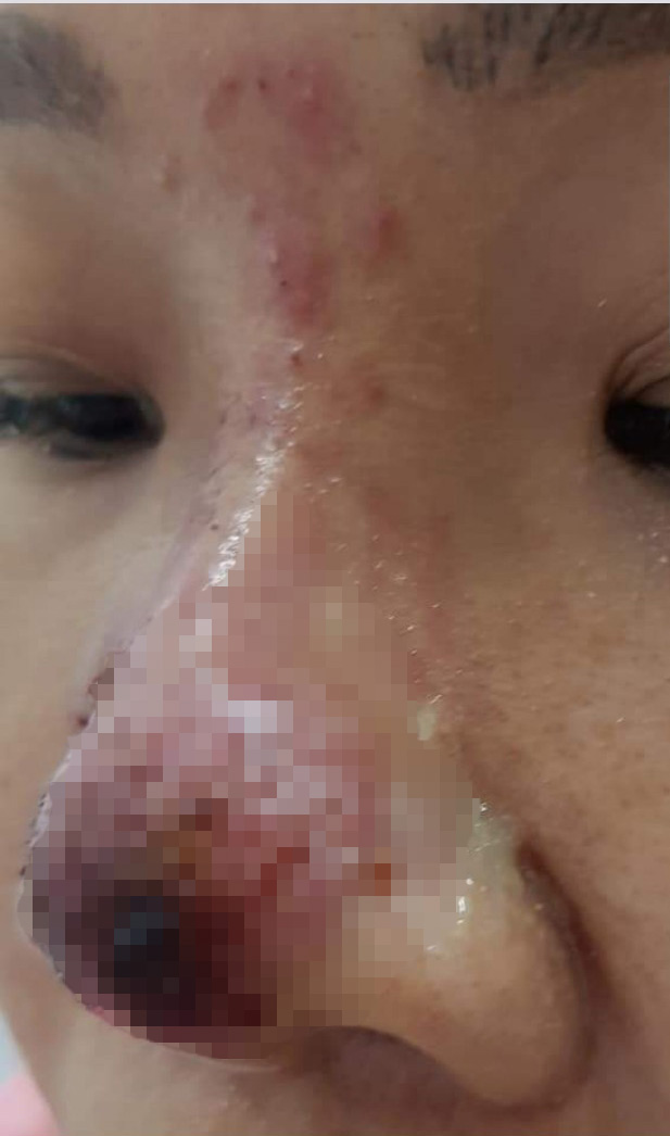 Làm gì khi bị biến chứng do tiêm filler?