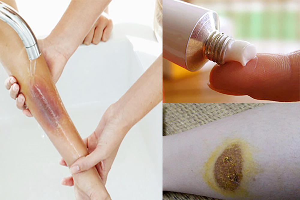 Xử lý để tránh sẹo phỏng bô xe máy Xử lý để tránh sẹo phỏng bô xe máy