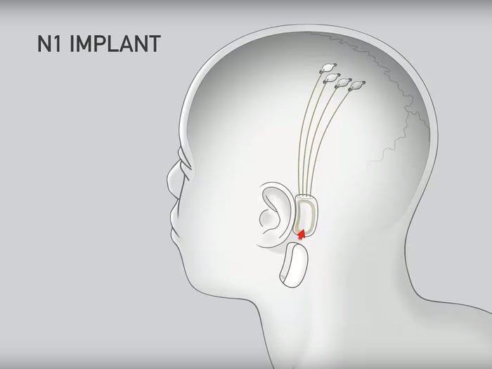 Ba công nghệ đột phá để tích hợp AI vào não người