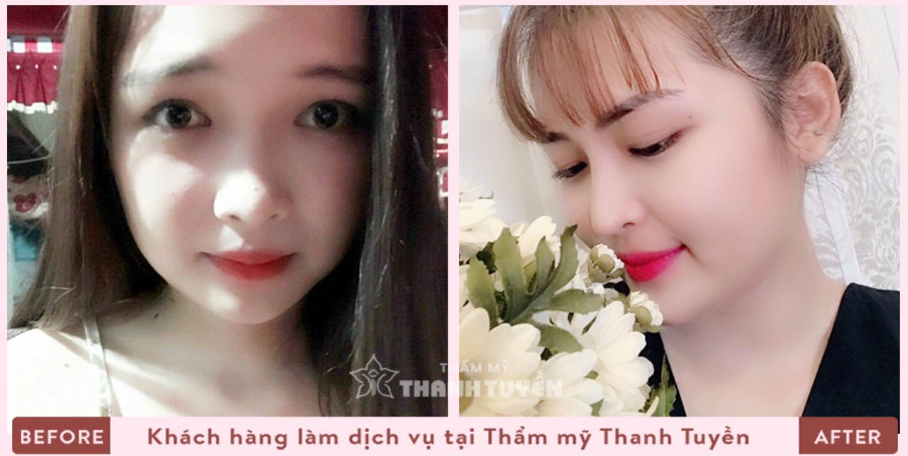 Những điều cần biết khi nâng mũi