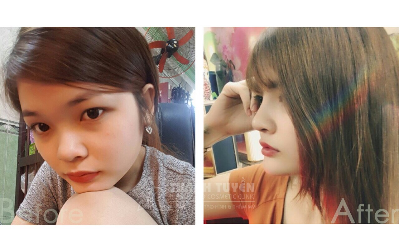 Những điều cần biết khi nâng mũi