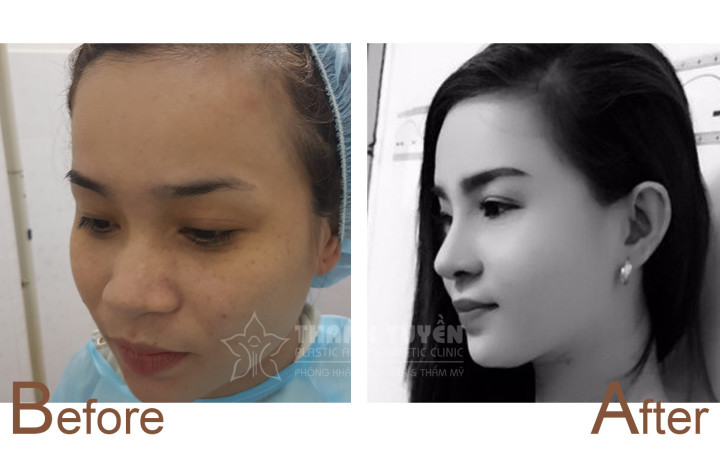 Những điều cần biết khi nâng mũi