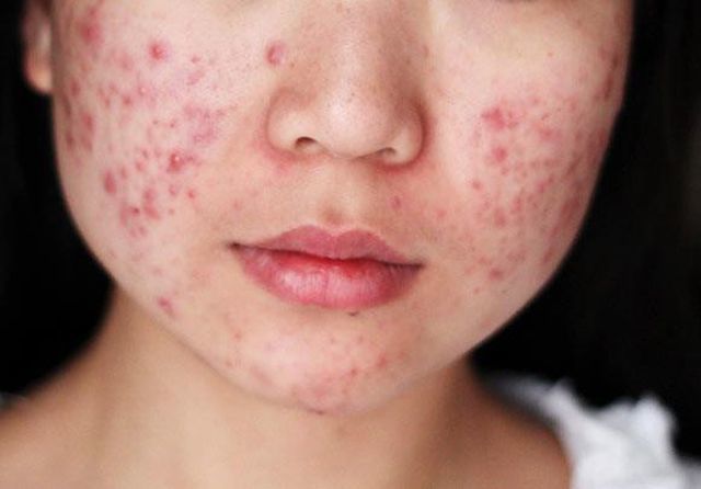 4 dấu hiệu trên khuôn mặt cảnh báo gan đang kêu cứu