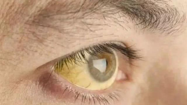 4 dấu hiệu trên khuôn mặt cảnh báo gan đang kêu cứu