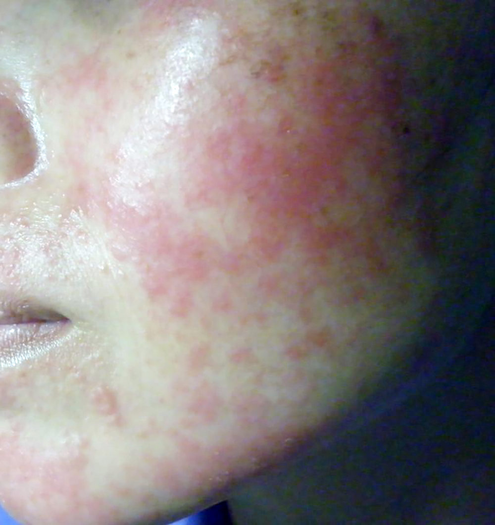 Tác hại của mỹ phẩm chứa corticoid