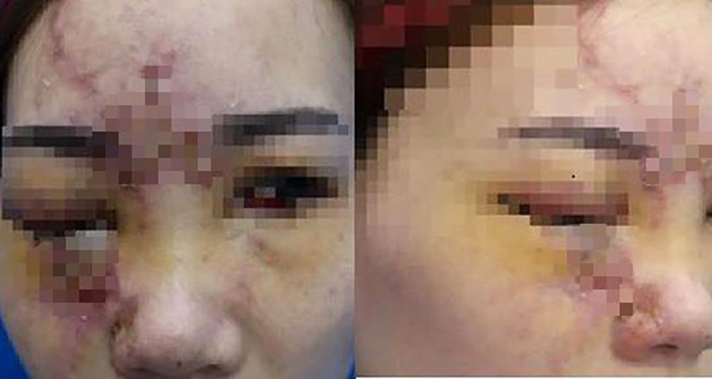 Khi filler bị lạm dụng tràn lan