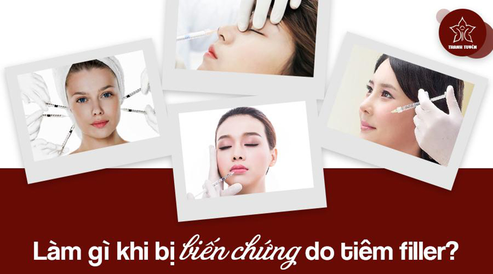 Khi filler bị lạm dụng tràn lan