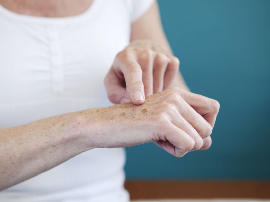Bí quyết chữa nám ở mu bàn tay cực đơn giản, bạn có biết?
