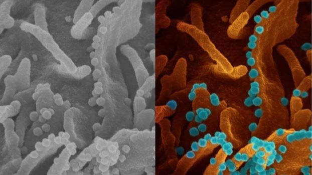 Hình ảnh tế bào virus SARS-CoV-2 sắp chết giải phóng các hạt virus mới