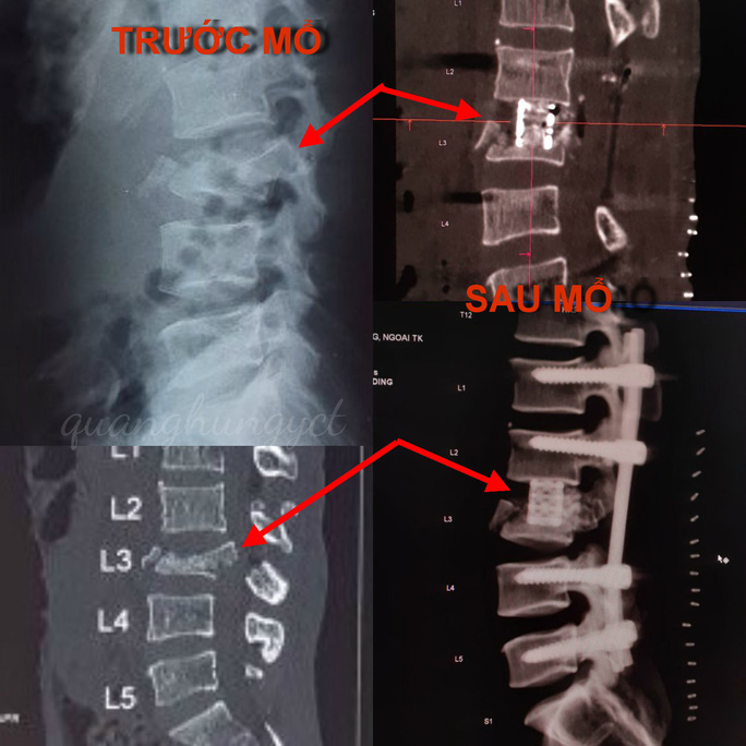 Cứu sống ngoạn mục thanh niên nghèo té cây dừa cao 5m khiến đốt sống gãy nát