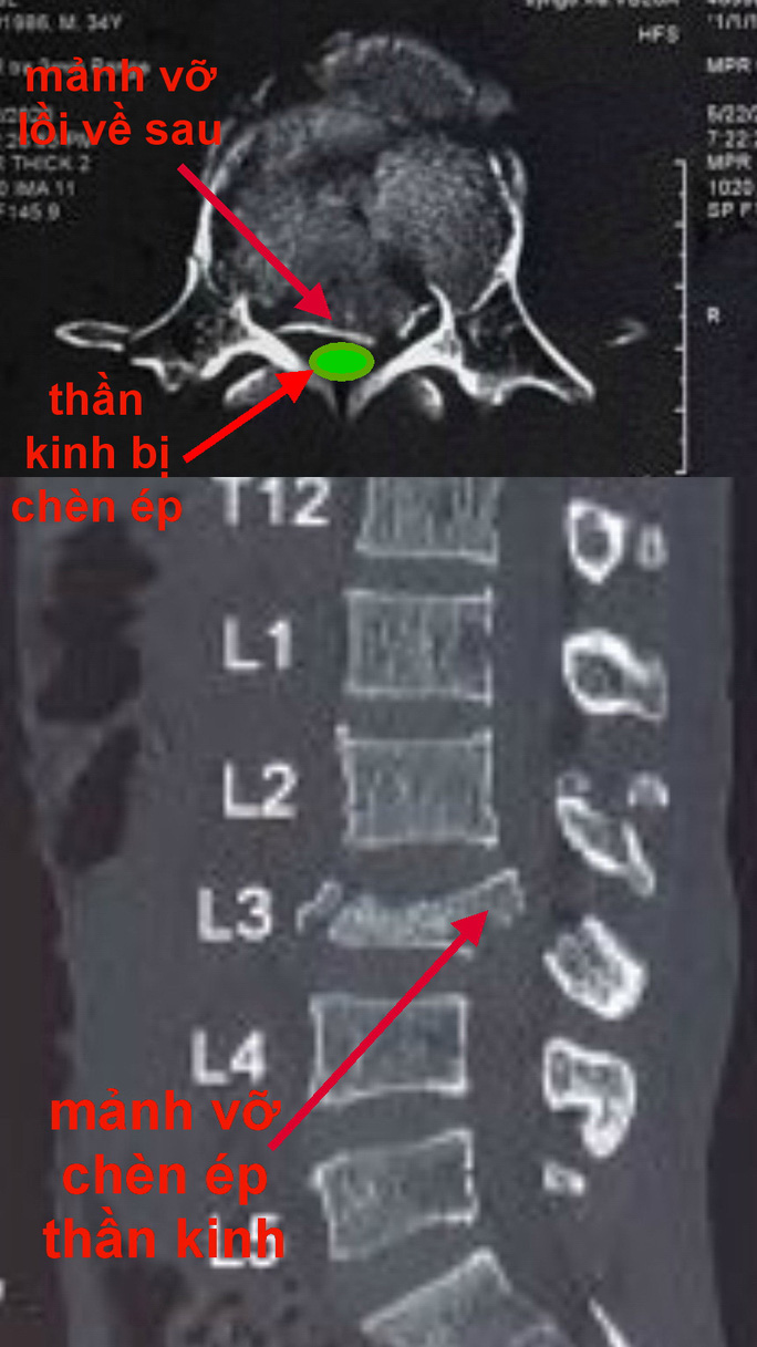 Cứu sống ngoạn mục thanh niên nghèo té cây dừa cao 5m khiến đốt sống gãy nát