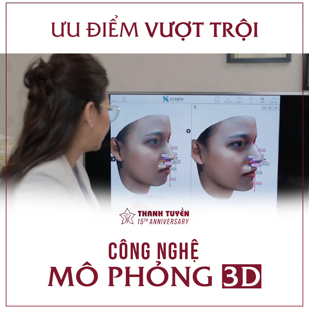 Công nghệ mô phỏng 3D tại thẩm mỹ Thanh Tuyền