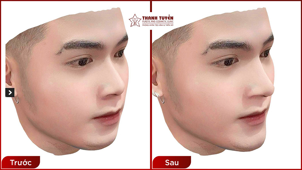 Công nghệ mô phỏng 3D tại thẩm mỹ Thanh Tuyền