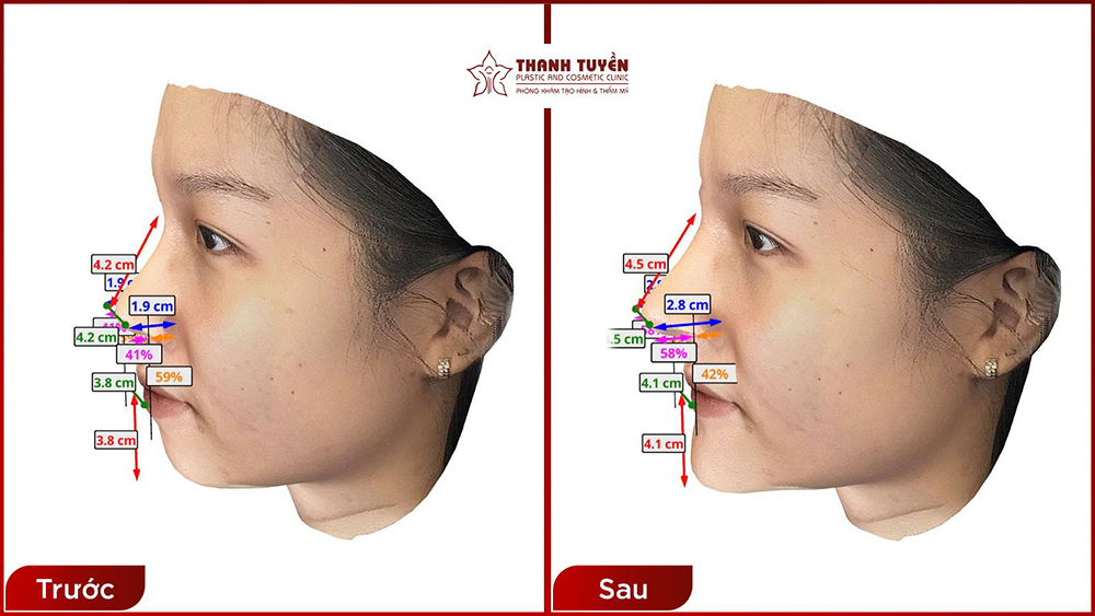 Công nghệ mô phỏng 3D tại thẩm mỹ Thanh Tuyền