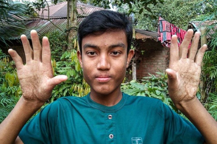 Kỳ lạ gia đình 4 thế hệ ở Bangladesh đều không có dấu vân tay