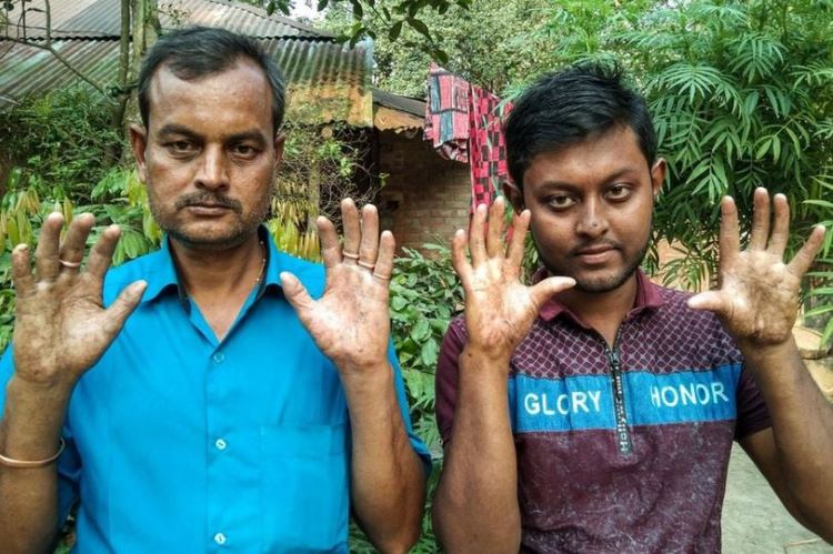 Kỳ lạ gia đình 4 thế hệ ở Bangladesh đều không có dấu vân tay