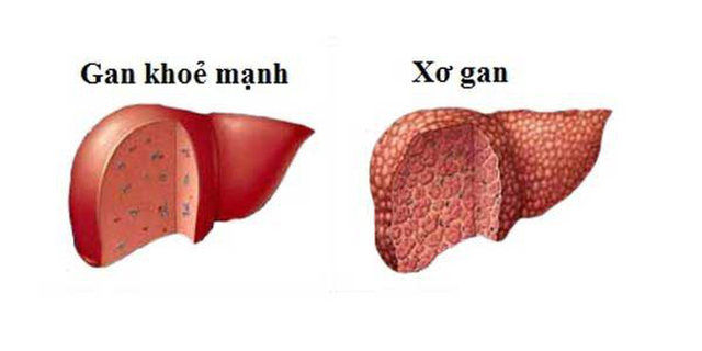 Chế độ ăn kìm hãm sự tiến triển của xơ gan