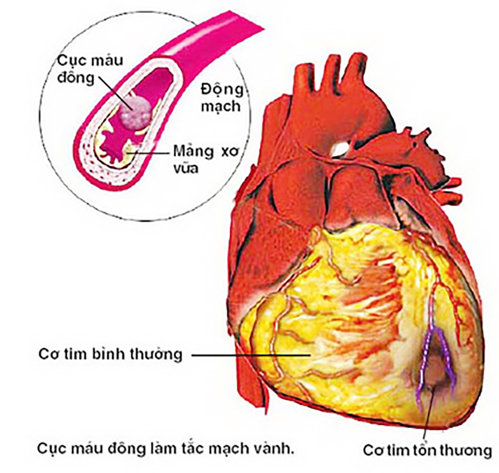 Hút thuốc lá - yếu tố nguy cơ của tăng huyết áp và các bệnh tim mạch
