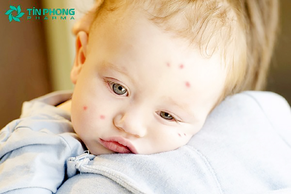 Dược phẩm Tín Phong tự tin thay mẹ bảo vệ an toàn làn da của bé tránh xa côn trùng đốt nhờ chiết xuất đặc biệt từ Kem Bebi