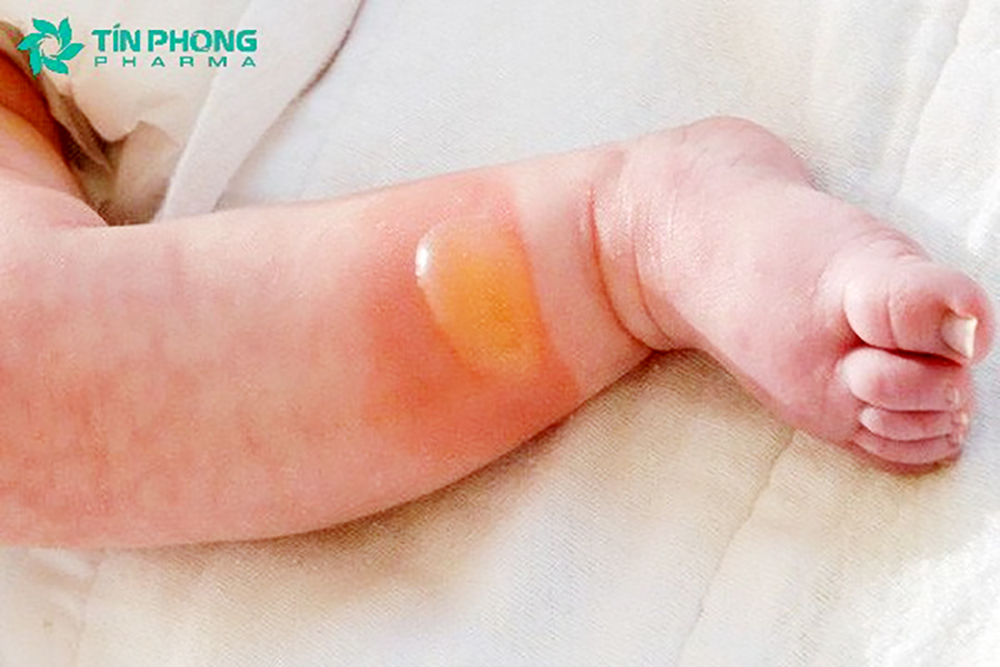 Dược phẩm Tín Phong tự tin thay mẹ bảo vệ an toàn làn da của bé tránh xa côn trùng đốt nhờ chiết xuất đặc biệt từ Kem Bebi