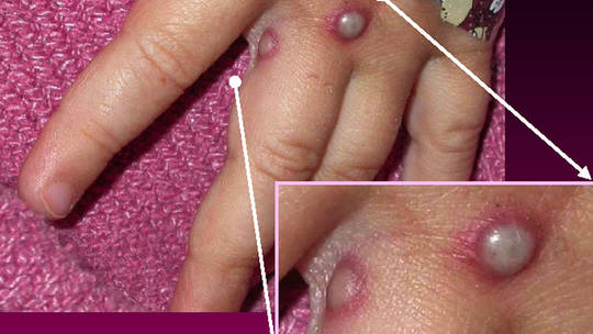 Mỹ ghi nhận ca đầu tiên mắc căn bệnh hiếm gặp đang lây lan ở châu Âu
