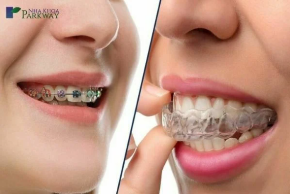Niềng răng trong suốt có hiệu quả không? Parkway