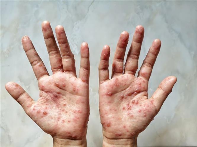 Nhật Bản ghi nhận ca đậu mùa khỉ đầu tiên