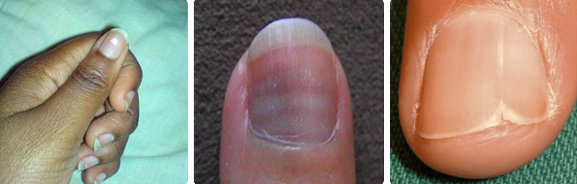 Móng tay, chân thêm đốm, sọc trắng, cảnh báo bệnh gì?