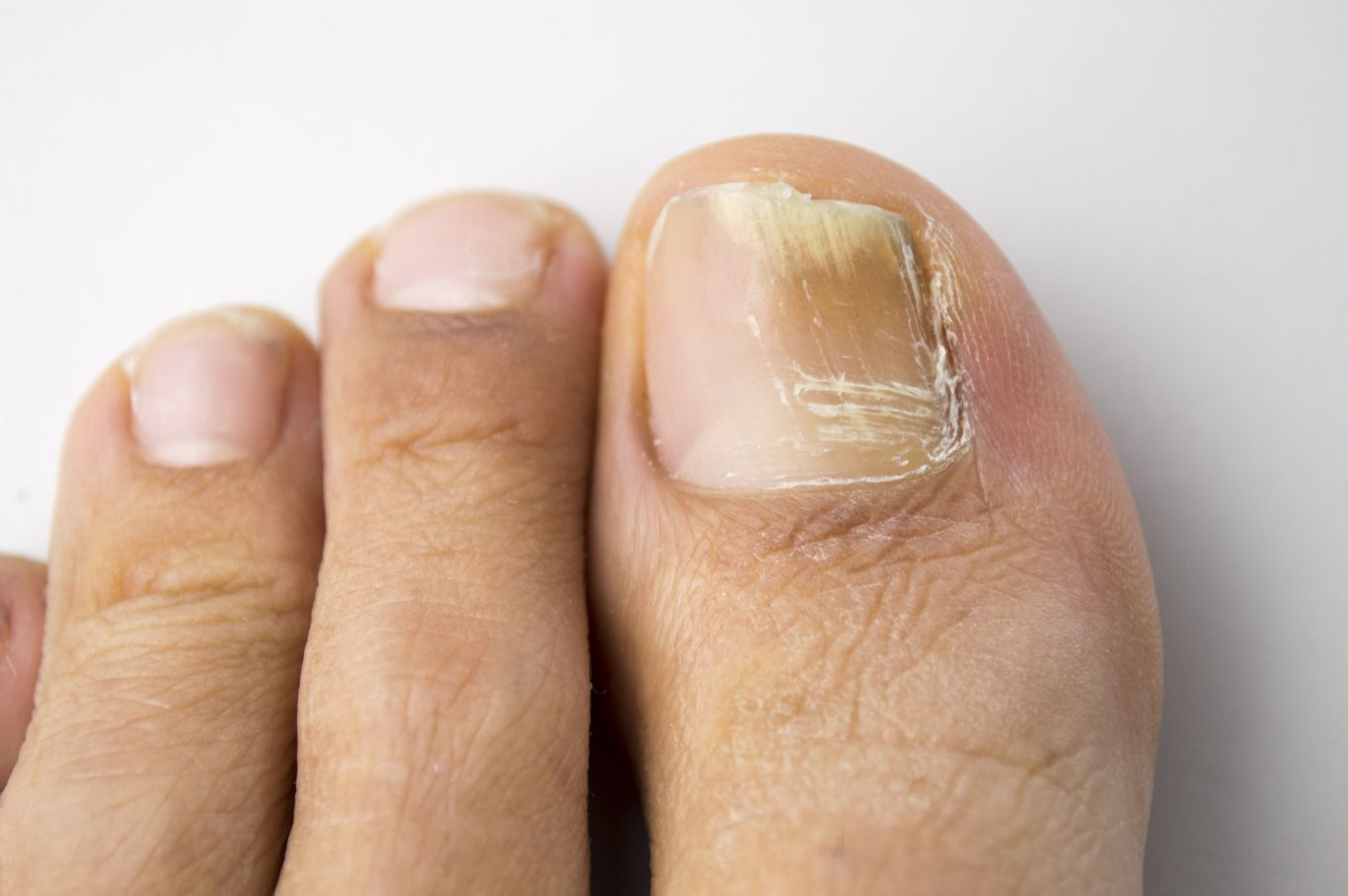 Móng tay, chân thêm đốm, sọc trắng, cảnh báo bệnh gì?