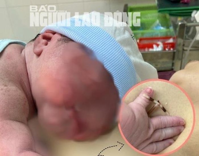 Bé gái chào đời cùng vòng tránh thai của mẹ