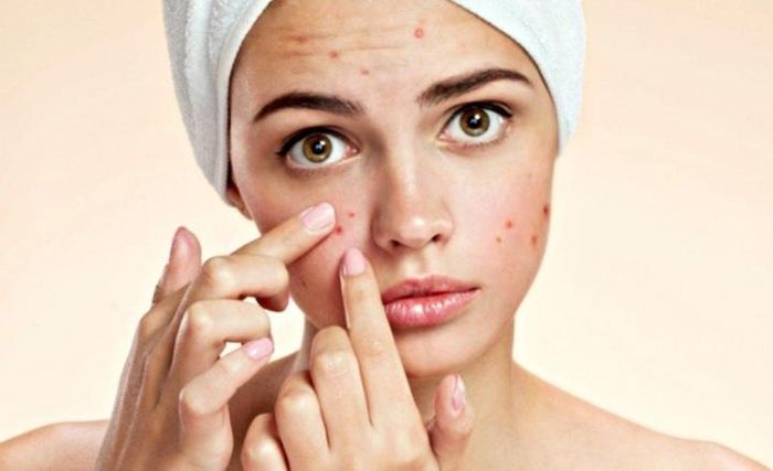 Mụn trứng cá gây thâm rỗ mặt: Bác sĩ da liễu mách cách chăm sóc da tốt nhất