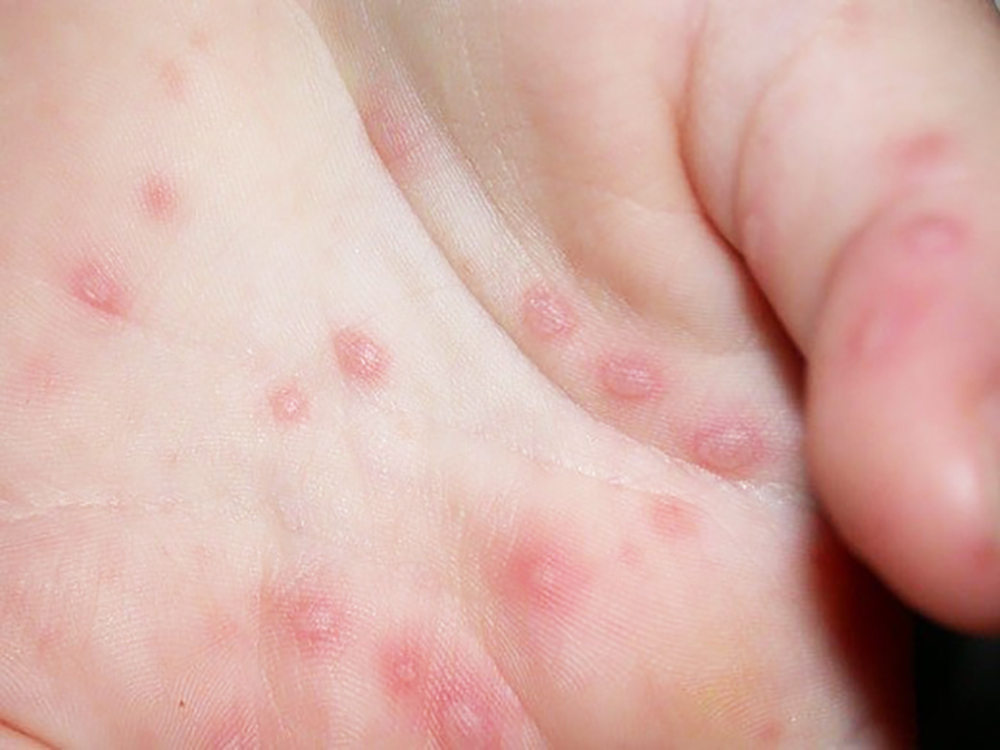 An Giang triển khai đồng bộ biện pháp phòng, chống dịch bệnh tay- chân- miệng