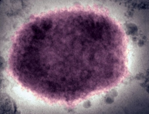 Bệnh đậu mùa khỉ: Các triệu chứng để xác định mắc bệnh là gì?