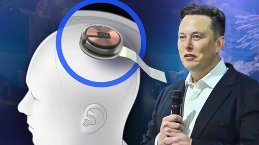 Chip não chữa bệnh của Elon Musk hoạt động như thế nào trong não người